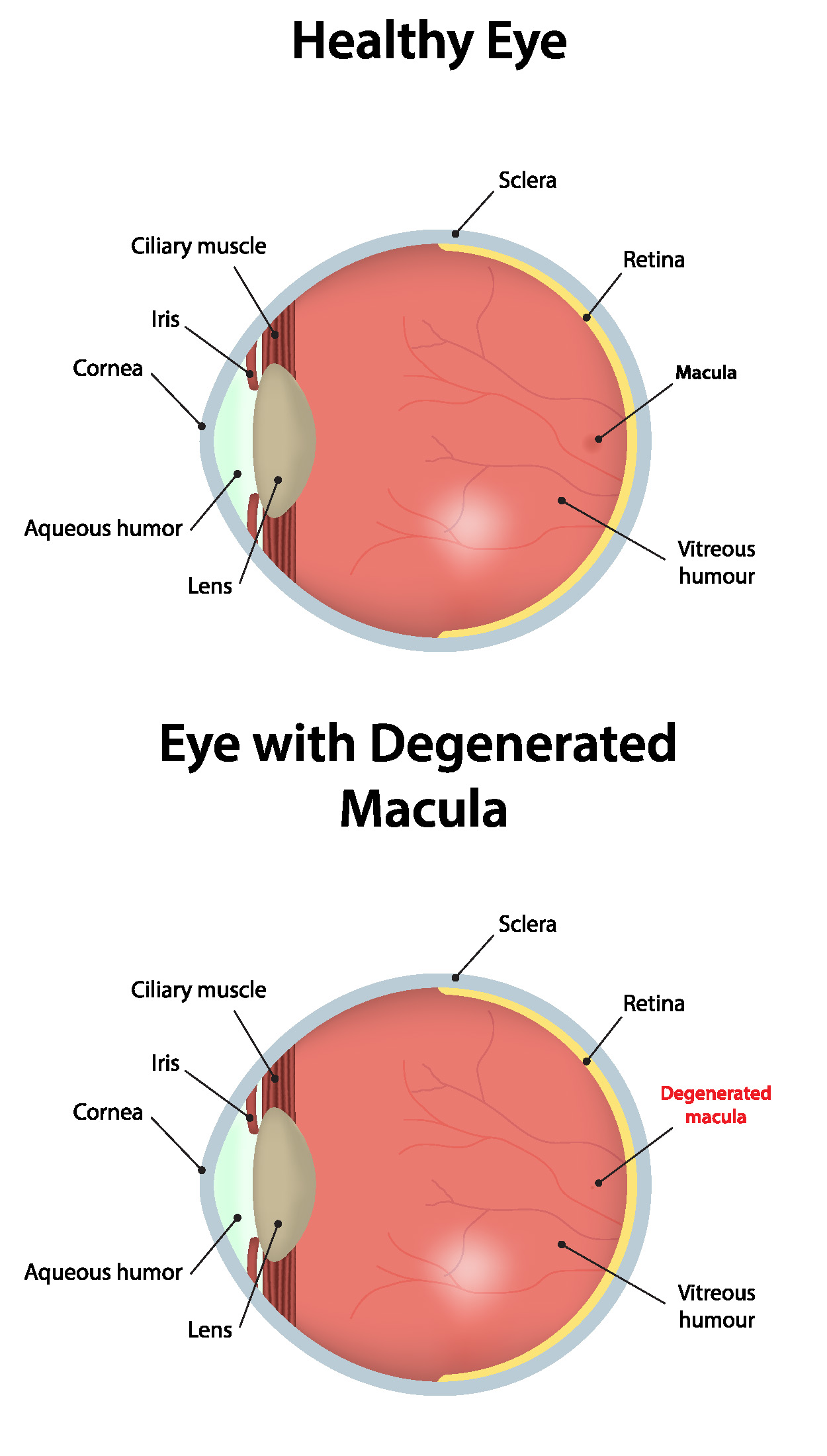 Macular Degeneration Eye Comparison