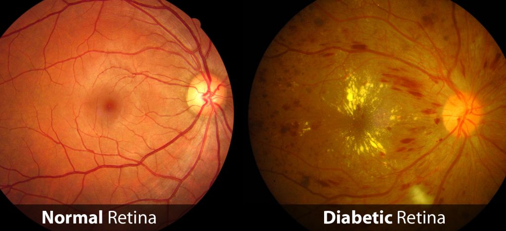 Normal and Diabetic Retina Comparison