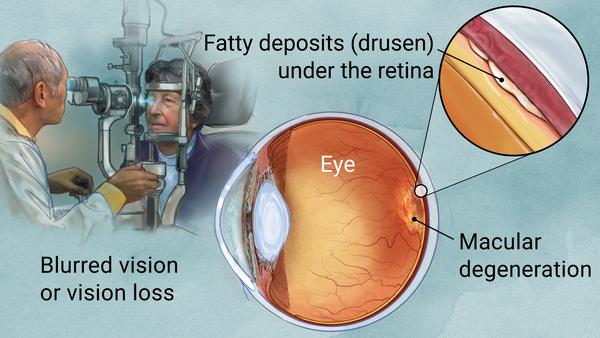 How Macular Degeneration Happens