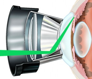 Selective Laser Trabeculoplasty