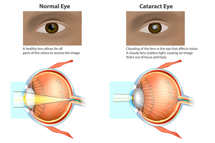 Does Medicare Cover Cataract Surgery Capitol Eye Care